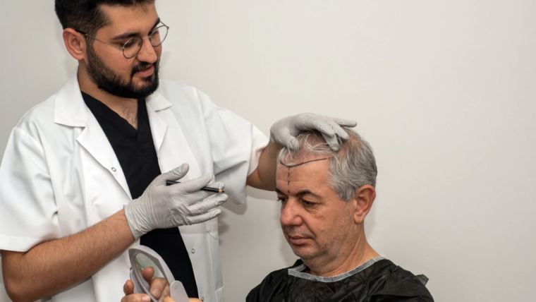 Finding the Best Provider for Hair Transplant Surgery Near Columbia, Maryland